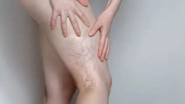 uzmanindan uyari ileri derecedeki varis hayati tehdit edebilir 8m6QpcRe.jpg