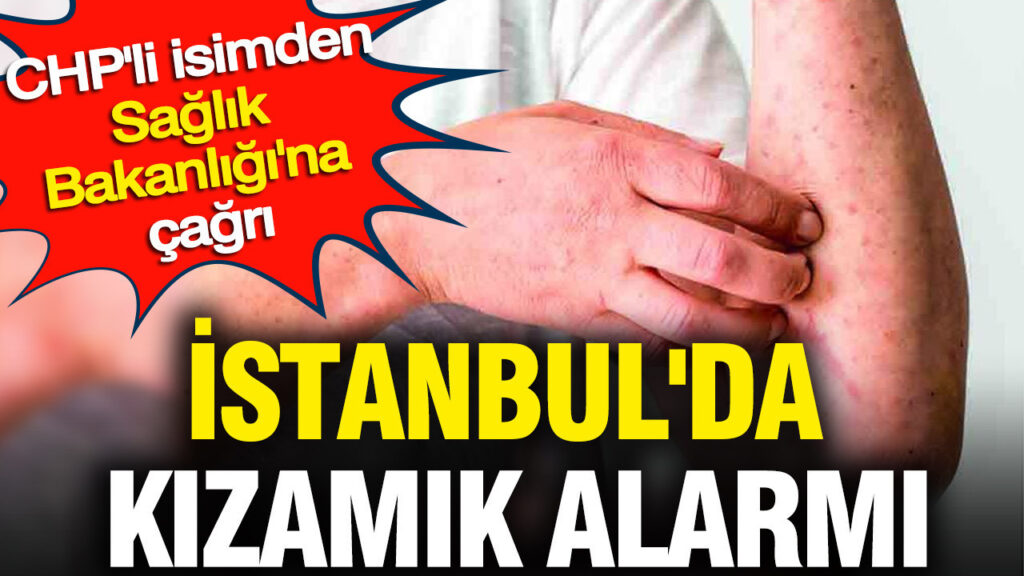 İstanbul’da Kızamık Vakaları Artıyor: CHP’li Vekilden Sağlık Bakanlığı’na Uyarı